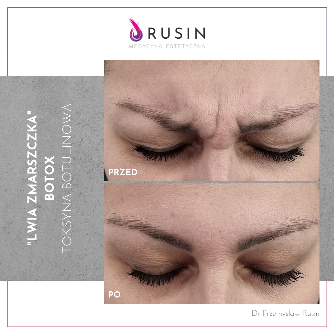 Zdjęcie 'przed i po' redukcji 'lwiej zmarszczki' toksyną botulinową w Toruniu, ukazujące różnicę w wyglądzie skóry między brwiami przed i po zabiegu, z widocznym logo firmy Rusin Medycyna Estetyczna.