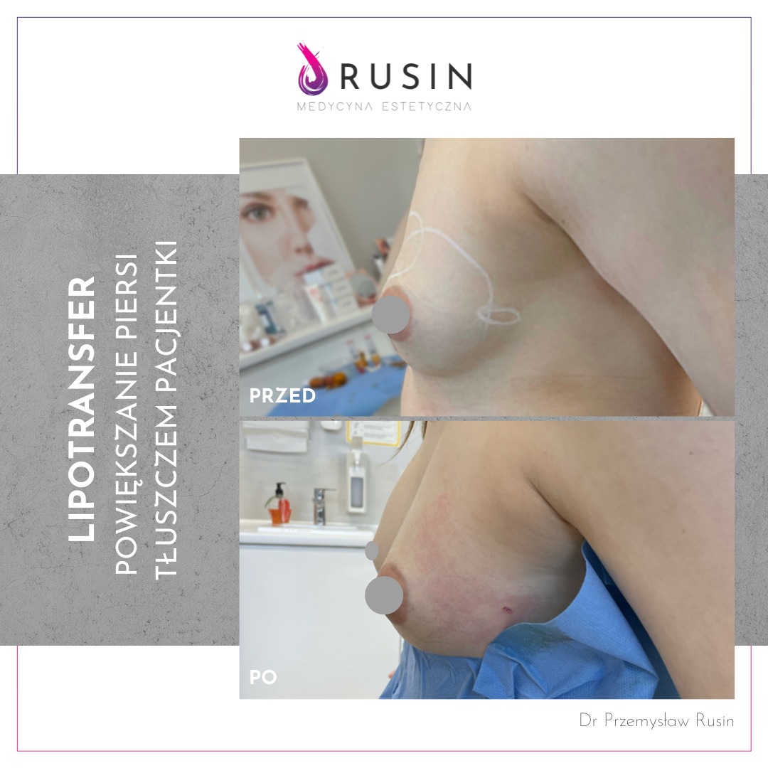 Zdjęcie porównawcze 'przed' i 'po' zabiegu lipotransferu piersi, widoczne narysowane linie na skórze przed zabiegiem oraz niewielkie zaczerwienienie po zabiegu, na tle gabinetu z preparatami.