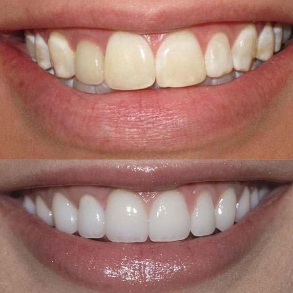 Porównanie uśmiechu przed i po zabiegu wybielania zębów lub założenia licówek, widoczne różnice w kolorze i kształcie zębów.