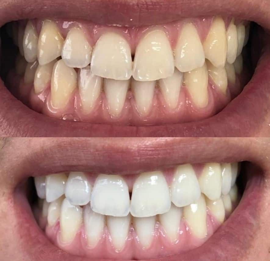 Porównanie stanu zębów przed i po zabiegu wybielania, widoczne różnice w odcieniu i połysku szkliwa.