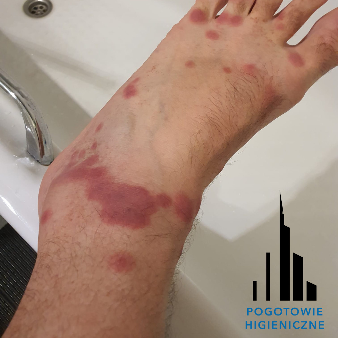 Stopa z widocznymi zmianami skórnymi, prawdopodobnie po ukąszeniach owadów, na tle białej umywalki i logotypu firmy dezynfekcyjnej w prawym dolnym rogu.