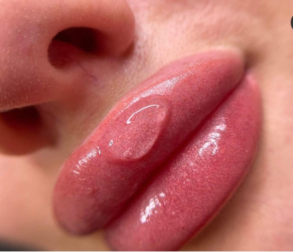 Zbliżenie na usta klientki po zabiegu powiększania, widoczna kropla preparatu na górnej wardze.