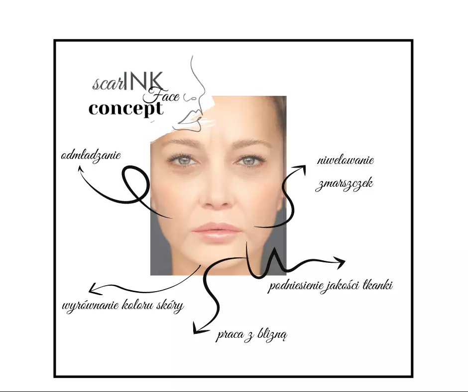 Grafika przedstawiająca twarz kobiety z zaznaczonymi strzałkami wskazującymi na obszary do odmładzania, niwelowania zmarszczek, podniesienia jakości tkanki, wyrównania koloru skóry oraz pracy...