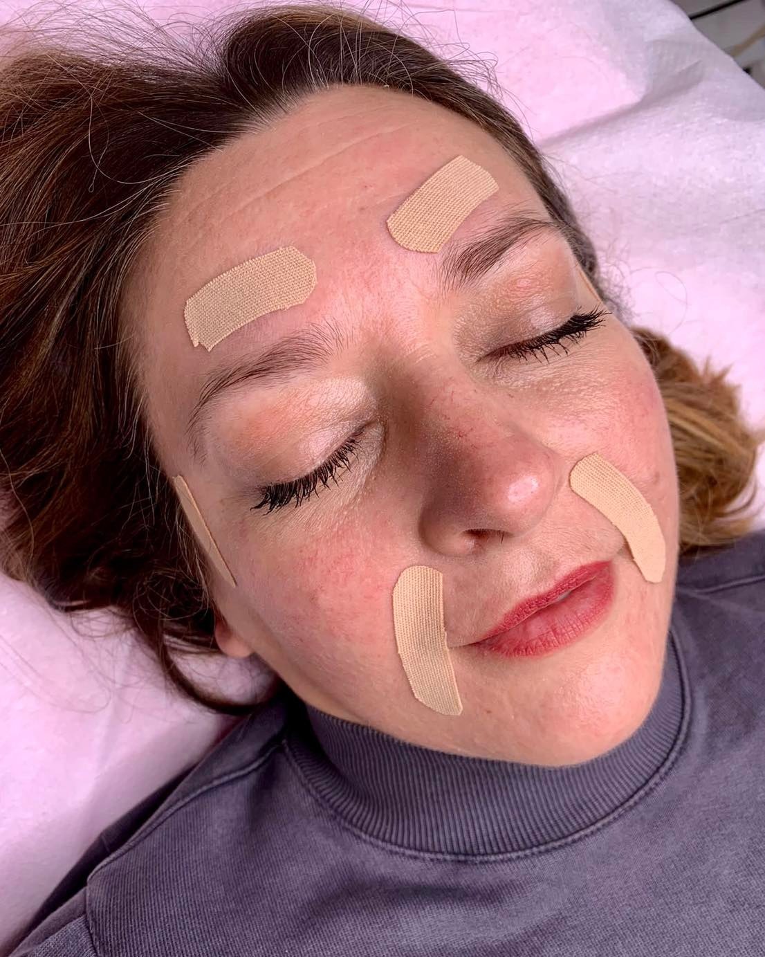 Kobieta z zamkniętymi oczami leżąca na różowym podłożu, z plastrami na czole i policzkach po zabiegu kosmetycznym, widoczne zaczerwienienia skóry.