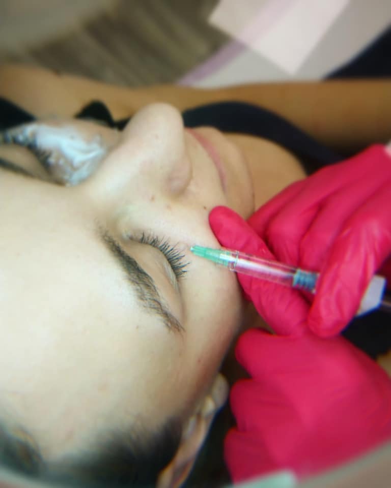 Aplikacja preparatu pod oczy igłą przez osobę w różowych rękawiczkach, widok z bliska na twarz klienta.