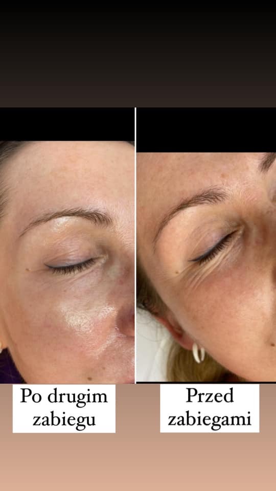 Porównanie skóry pod okiem przed i po drugim zabiegu kosmetycznym, widoczne zmniejszenie zaczerwienienia i poprawa napięcia skóry.