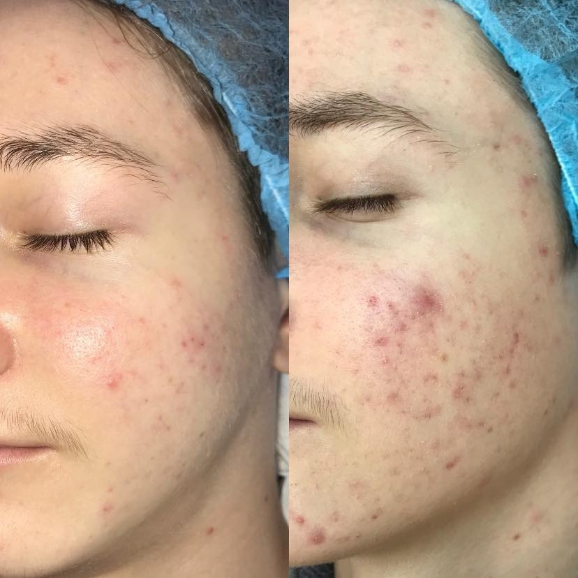 Zdjęcie 'przed i po' zabiegu kosmetycznego na twarz z problemami trądzikowymi, widoczne zaczerwienienia i zmiany skórne, pacjent w czepku ochronnym.