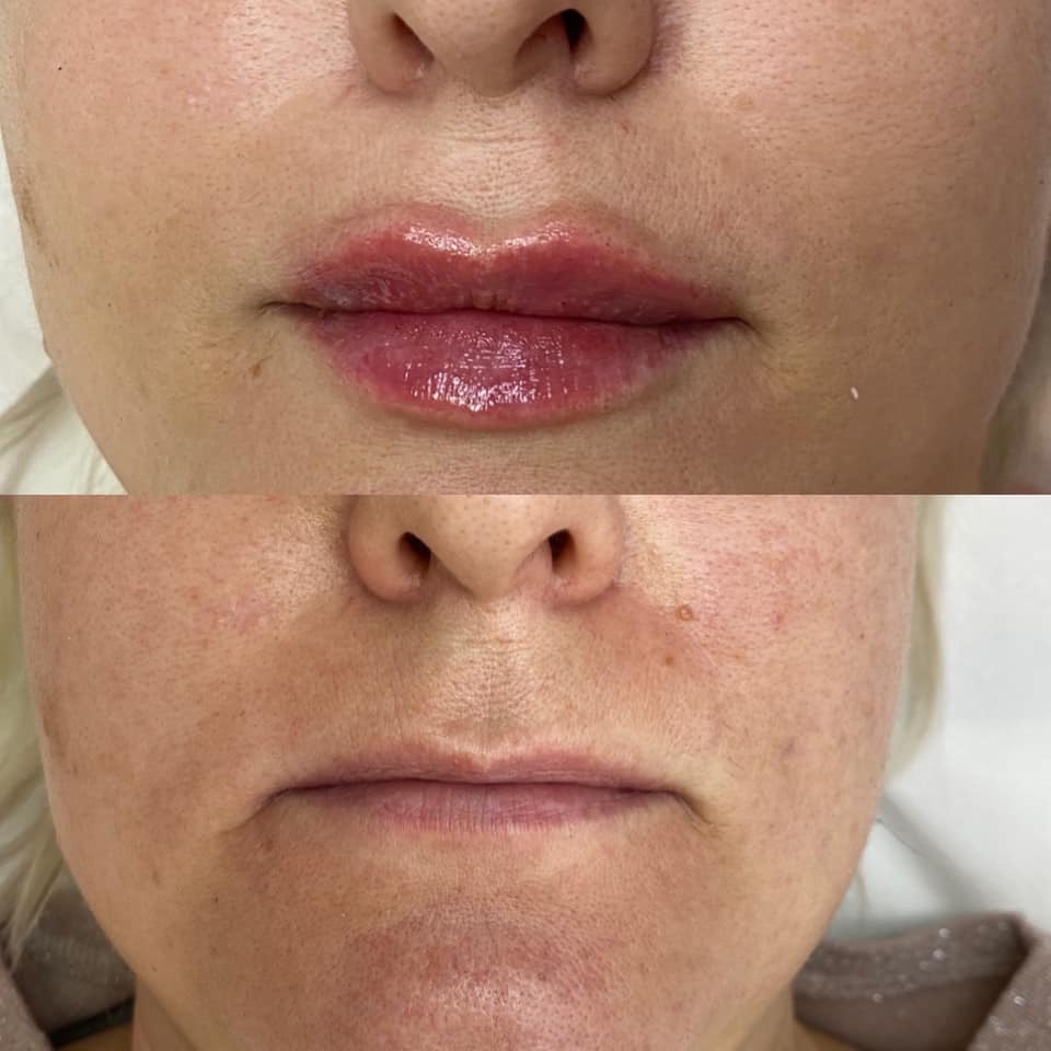 Porównanie ust przed i po zabiegu powiększania, widoczne zaczerwienienie i błyszczący efekt po zabiegu.