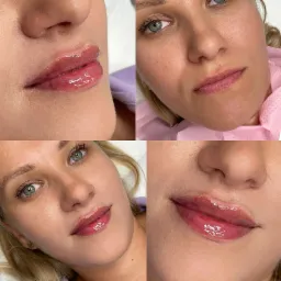 Cztery zbliżenia na twarz kobiety po zabiegu powiększania ust, ukazujące efekt nawilżonych, pełnych ust z subtelnym połyskiem, oraz świeżą cerę.