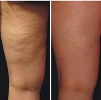 Masaz antycellulitowy