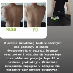 Porównanie sylwetki pleców pacjenta przed i po terapii, widoczne zmiany w postawie i napięciu mięśniowym, obok terapeuta z akcesoriami do rehabilitacji.
