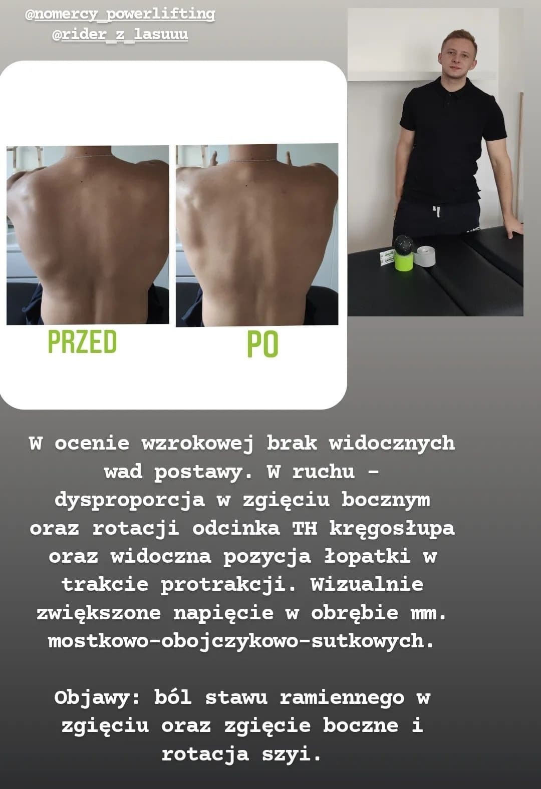 Porównanie sylwetki pleców pacjenta przed i po terapii, widoczne zmiany w postawie i napięciu mięśniowym, obok terapeuta z akcesoriami do rehabilitacji.