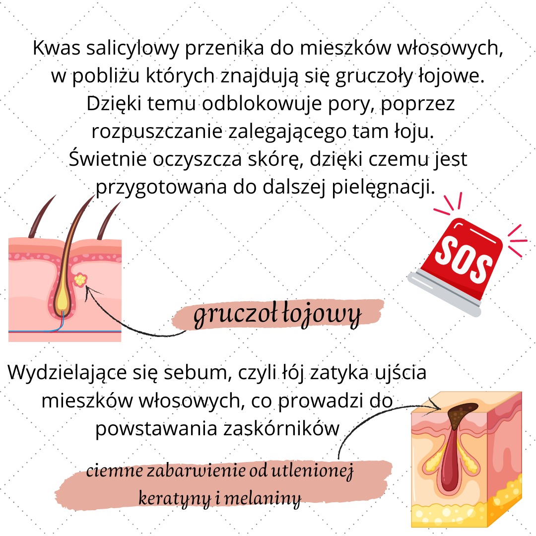 Ilustracja edukacyjna przedstawiająca przekrój skóry z zaznaczonymi mieszkami włosowymi, gruczołami łojowymi i proces powstawania zaskórników, obok tekst wyjaśniający działanie kwasu salicylowego.
