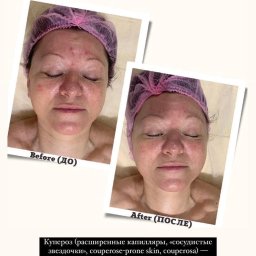 Facemassage_yakovenko - Zdjęcie typu 'przed i po' przedstawiające twarz kobiety z widocznymi zmianami naczyniowymi (kuperozą) przed i po serii zabiegów, z podpisami 'Before' i 'After'.