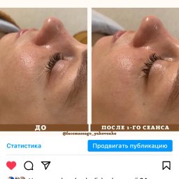 Facemassage_yakovenko - Porównanie skóry wokół oka przed i po pierwszym zabiegu, redukcja zmarszczek mimicznych typu kurze łapki.