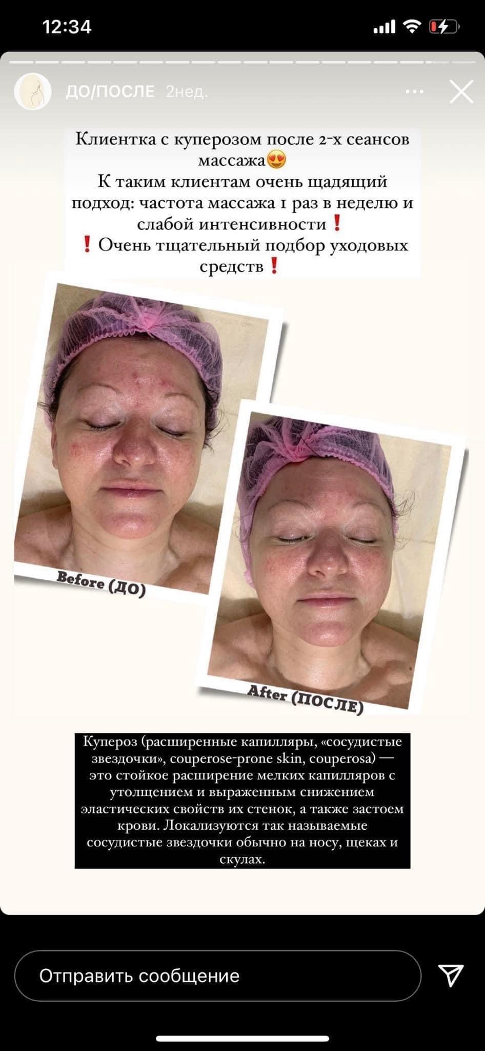 Zdjęcie typu 'przed i po' przedstawiające twarz kobiety z widocznymi zmianami naczyniowymi (kuperozą) przed i po serii zabiegów, z podpisami 'Before' i 'After'.