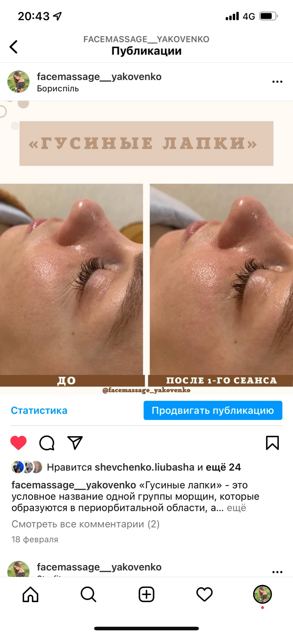 Porównanie skóry wokół oka przed i po pierwszym zabiegu, redukcja zmarszczek mimicznych typu kurze łapki.