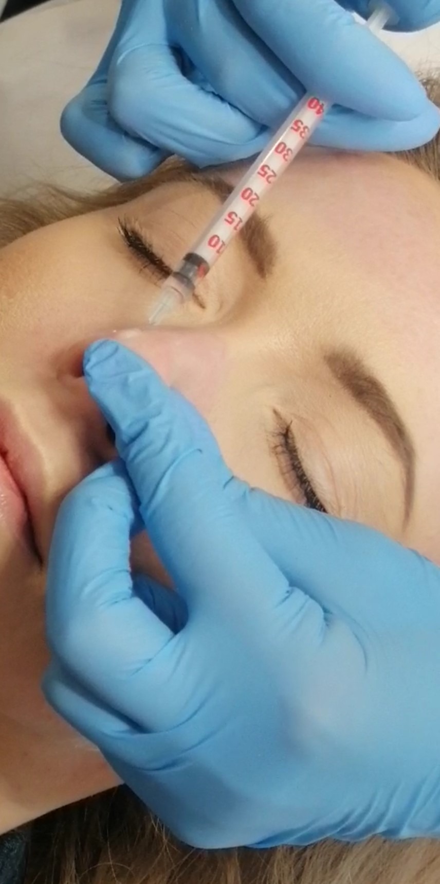 Zwężanie skrzydełek noska