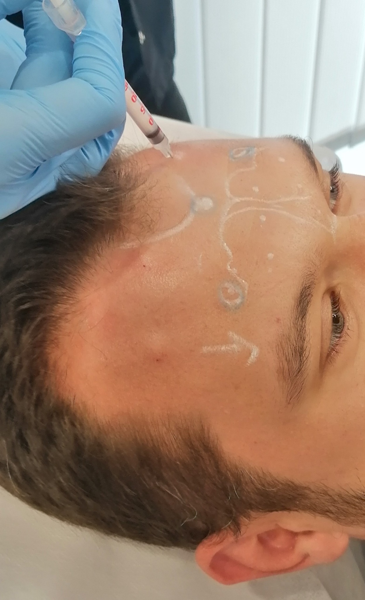 Botoks okolica czoło i brwi