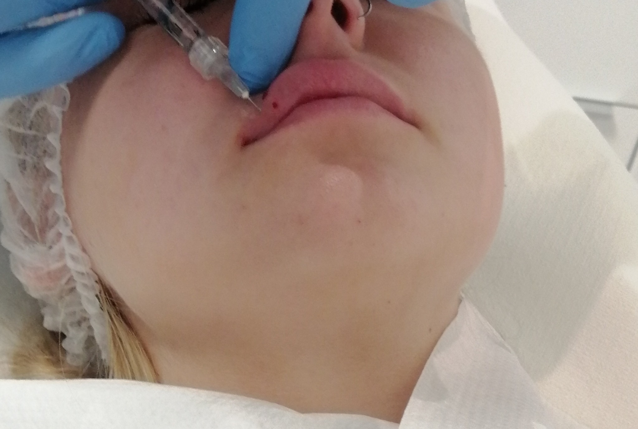 Powiększanie ust kwasem hialuronowym