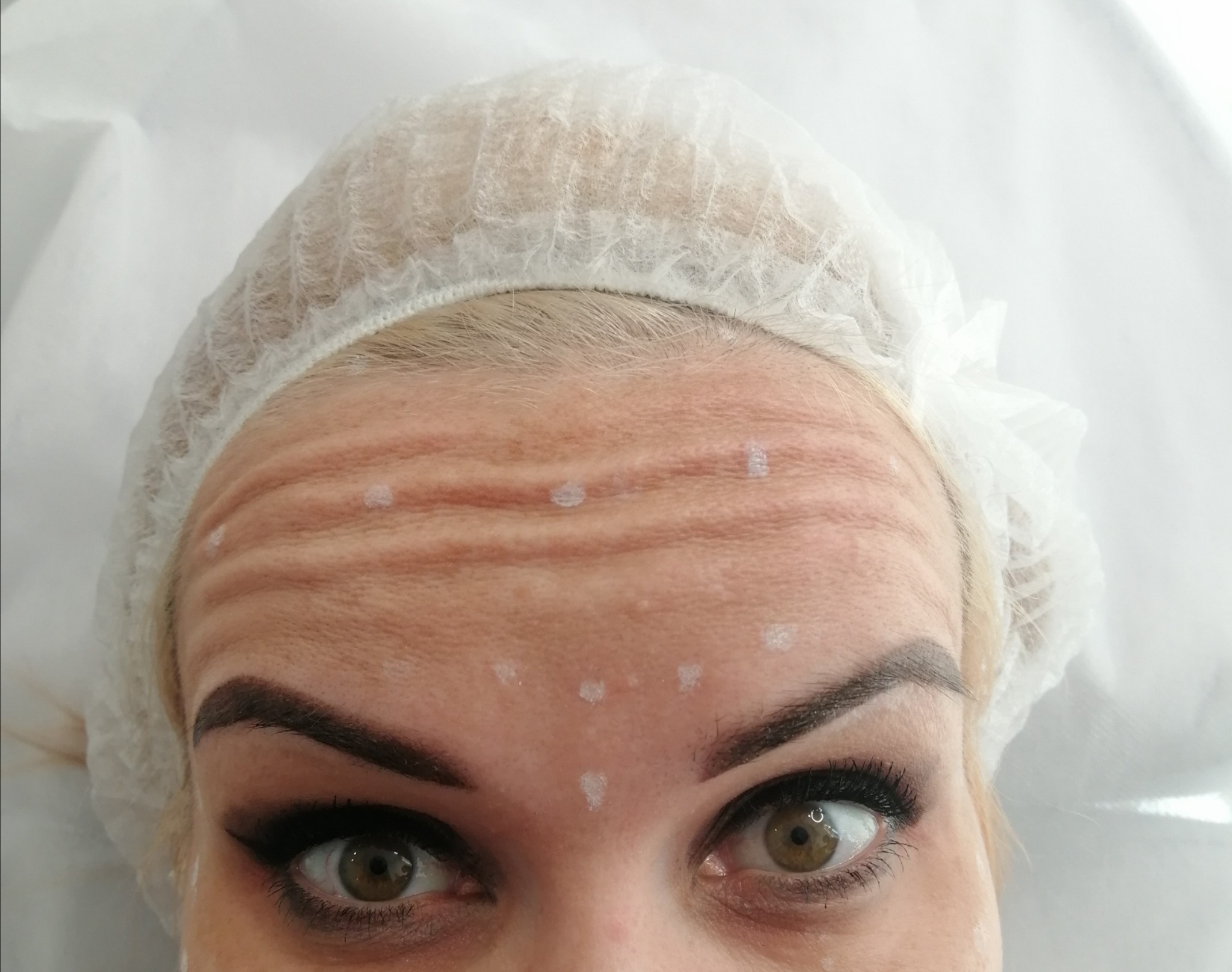 Czółko - oznaczone punkty podania toksyny botulinowej:)