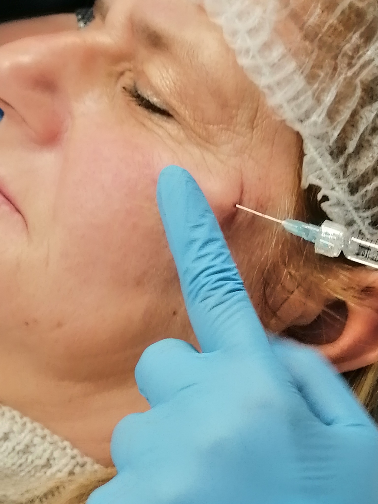 Wypełnienie policzków tzw. wolumetria z użyciem kaniuli i kwasu hialuronowego wysoko usieciowanego.