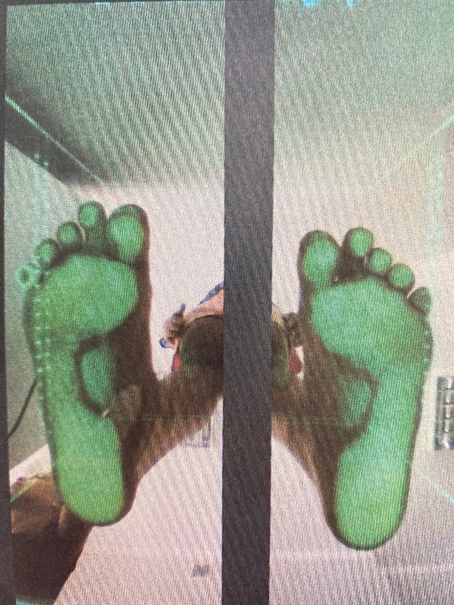 Stopy pacjenta poddane badaniu na platformie diagnostycznej, z zielonymi obszarami wskazującymi na punkty nacisku.