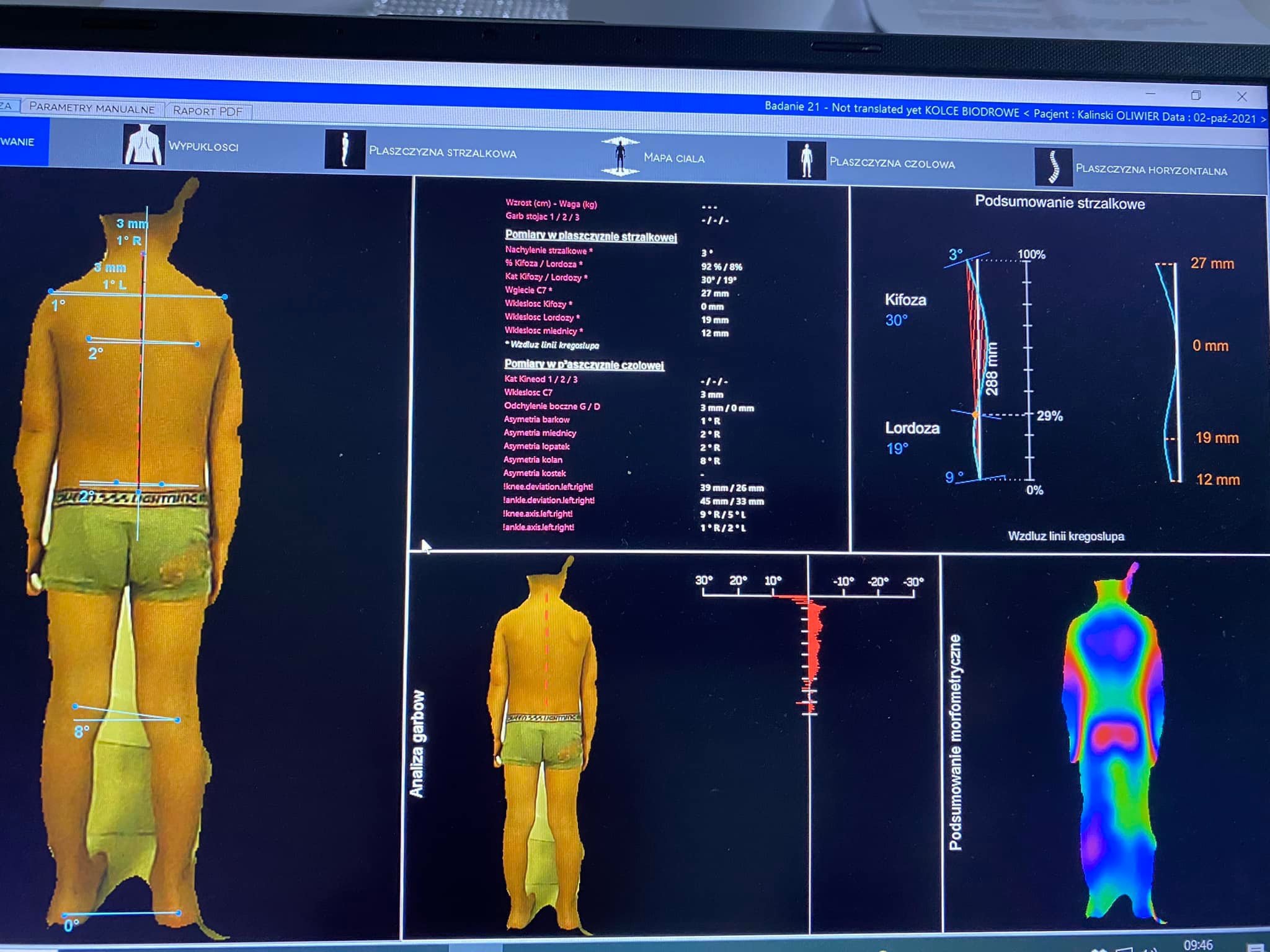 Skan analizy postawy ciała pacjenta, prezentujący pomiary strzałkowe i czołowe kręgosłupa z zaznaczonymi odchyleniami i asymetriami, wyświetlony na ekranie komputera.