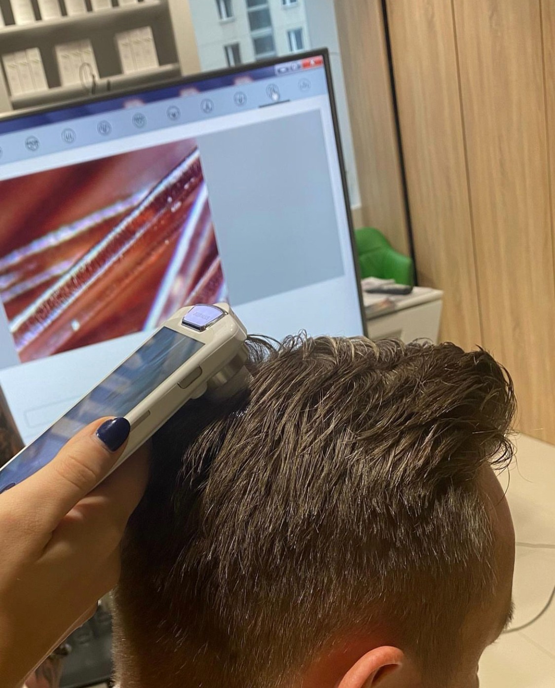 Trichoskopia skóry głowy pacjenta podczas badania, widoczny powiększony obraz włosów na ekranie monitora.