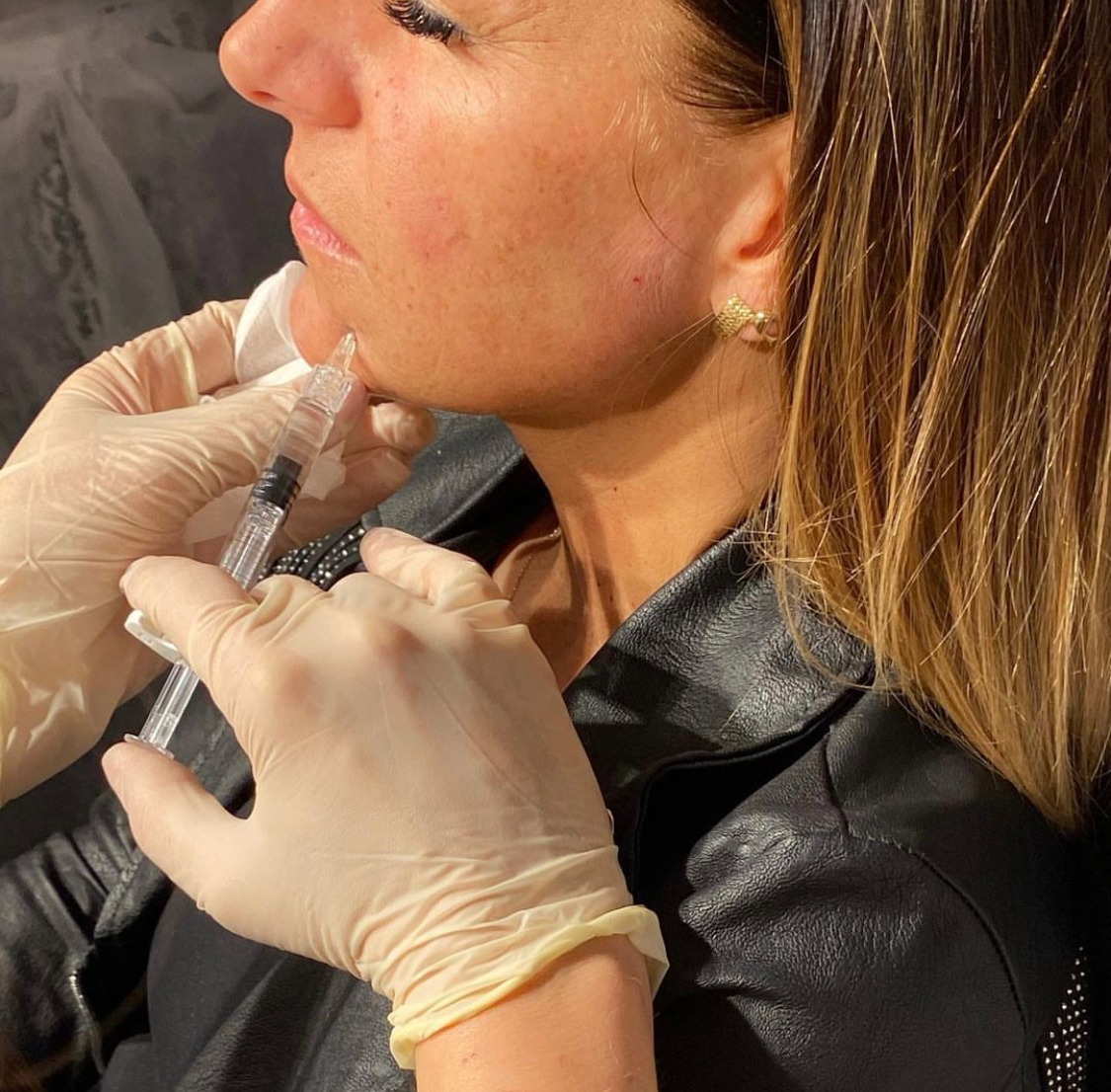 Kobieta podczas zabiegu modelowania brody z użyciem wypełniacza, widoczne rękawice ochronne i strzykawka z preparatem, skóra zaczerwieniona w miejscu iniekcji.