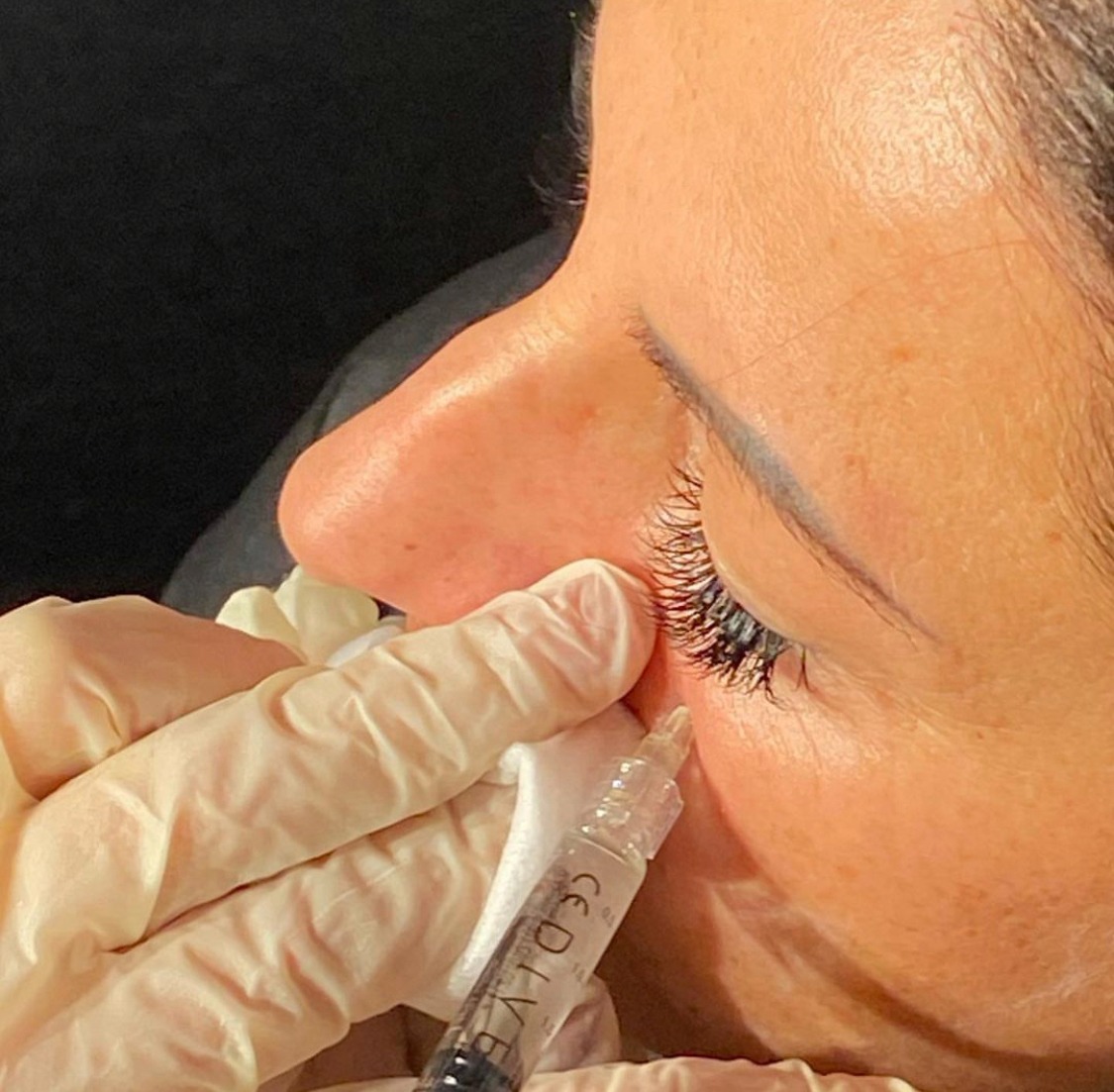 Wypełnianie zmarszczek pod okiem za pomocą iniekcji preparatem CEDITVE, widoczna igła w skórze i rękawice ochronne.