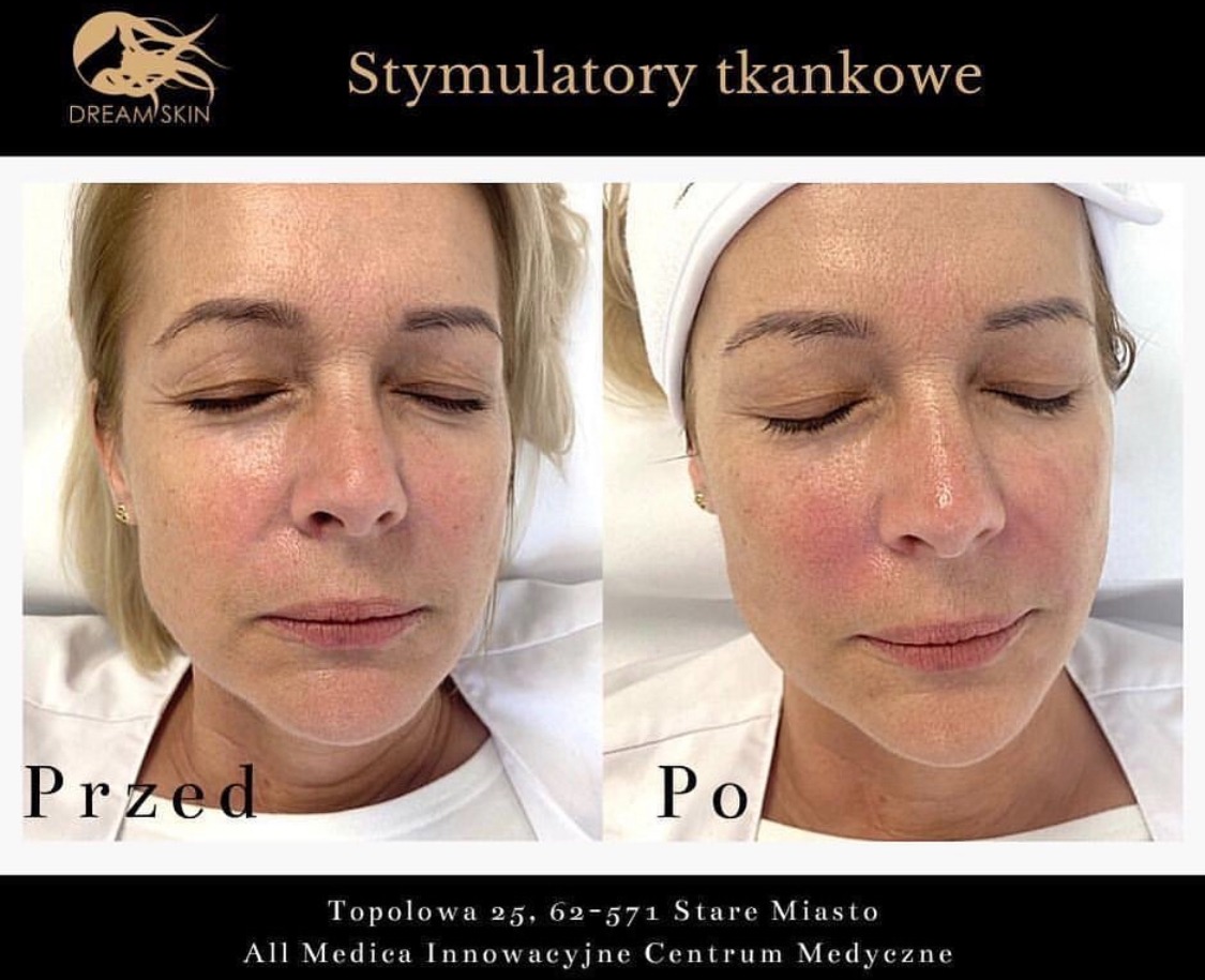 Zdjęcie typu przed i po prezentujące efekty zabiegu stymulacji tkankowej na twarzy kobiety, widoczne zaczerwienienie skóry po zabiegu.