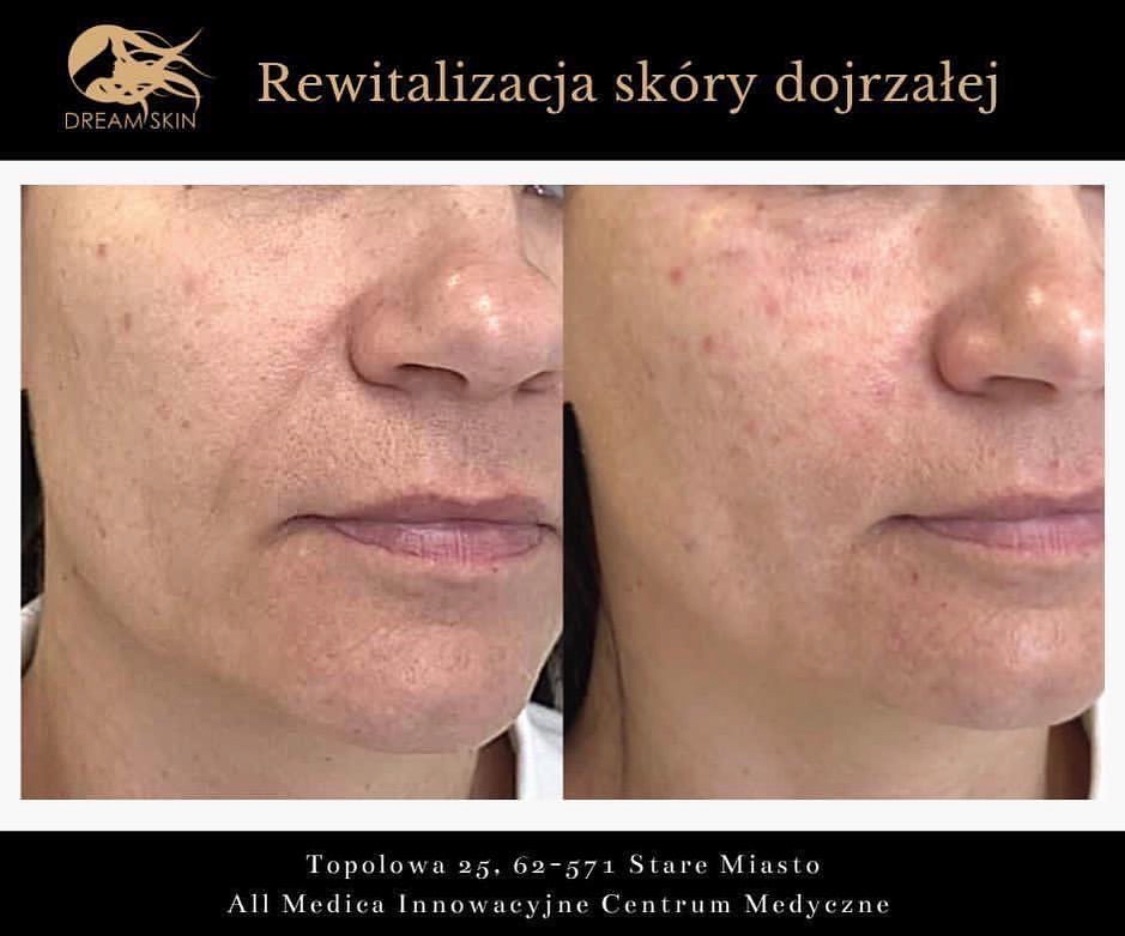 Porównanie skóry twarzy kobiety przed i po zabiegu rewitalizacji, widoczne zmniejszenie przebarwień i poprawa ogólnego wyglądu.