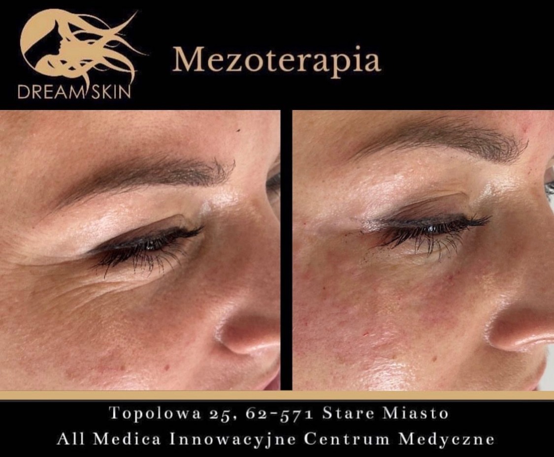 Zbliżenie na skórę pod okiem przed i po zabiegu mezoterapii, widoczne zmniejszenie zmarszczek i zaczerwienień.