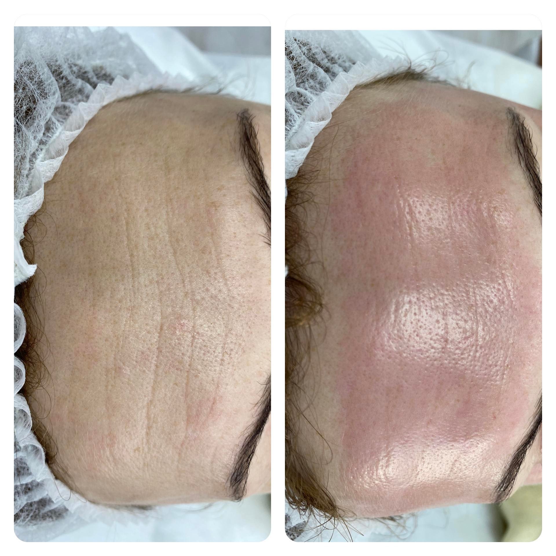 Zbliżenie na twarz kobiety przed i po zabiegu na skórę, widoczne zmniejszenie zmarszczek i poprawa kolorytu, włosy zabezpieczone czepkiem.