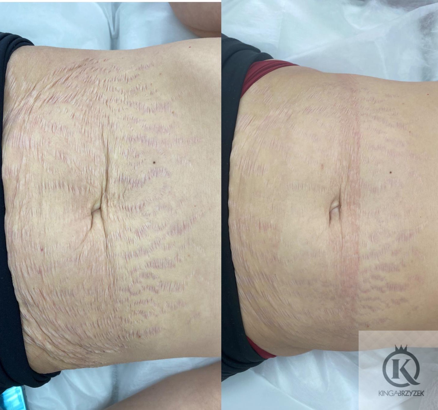 Zdjęcie typu przed i po, przedstawiające brzuch kobiety z widocznymi rozstępami przed zabiegiem (po lewej) i po zabiegu (po prawej), z widoczną redukcją rozstępów. W prawym dolnym rogu widoczne...