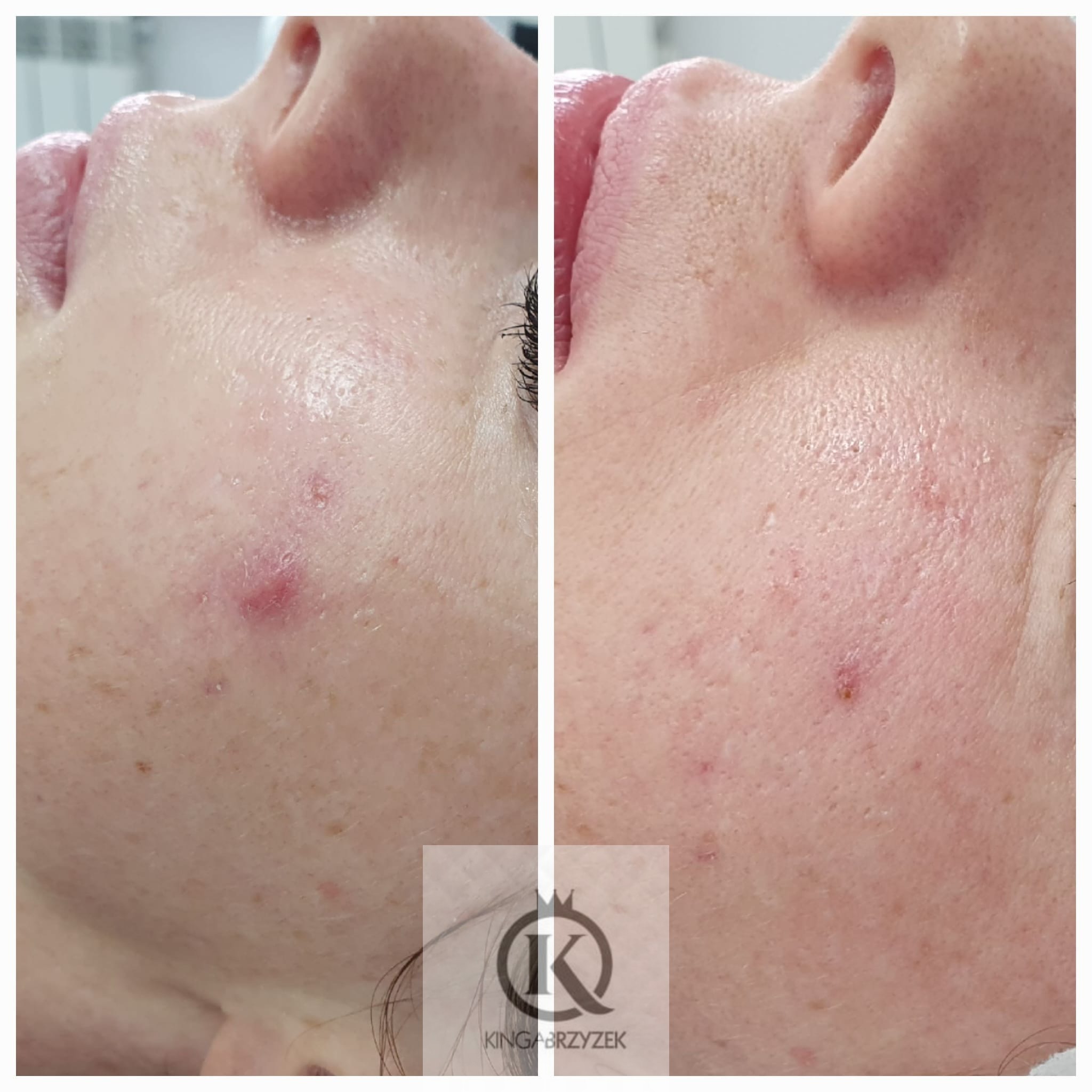 Zdjęcie typu 'przed i po' przedstawiające skórę twarzy z problemami trądzikowymi przed i po zabiegu. Na zdjęciu po prawej widać zmniejszenie zaczerwienienia i poprawę stanu skóry.