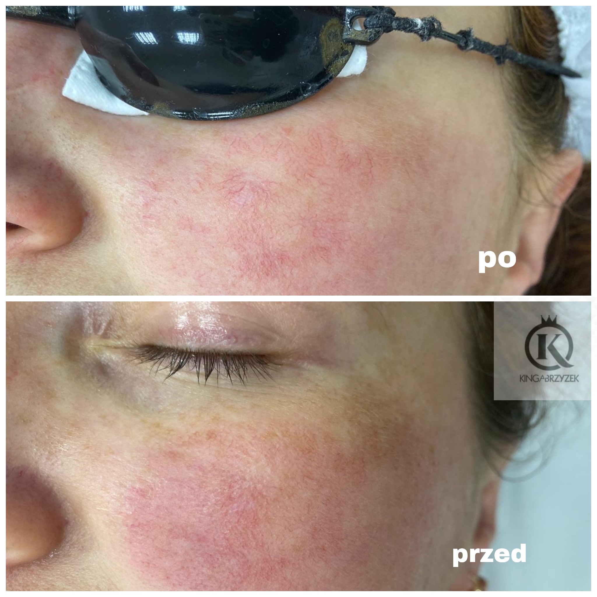 Zbliżenie na skórę twarzy kobiety przed i po zabiegu redukcji naczynek, widoczne zaczerwienienia i naczynka przed zabiegiem oraz ich znaczne zmniejszenie po, górna część twarzy chroniona okularami...