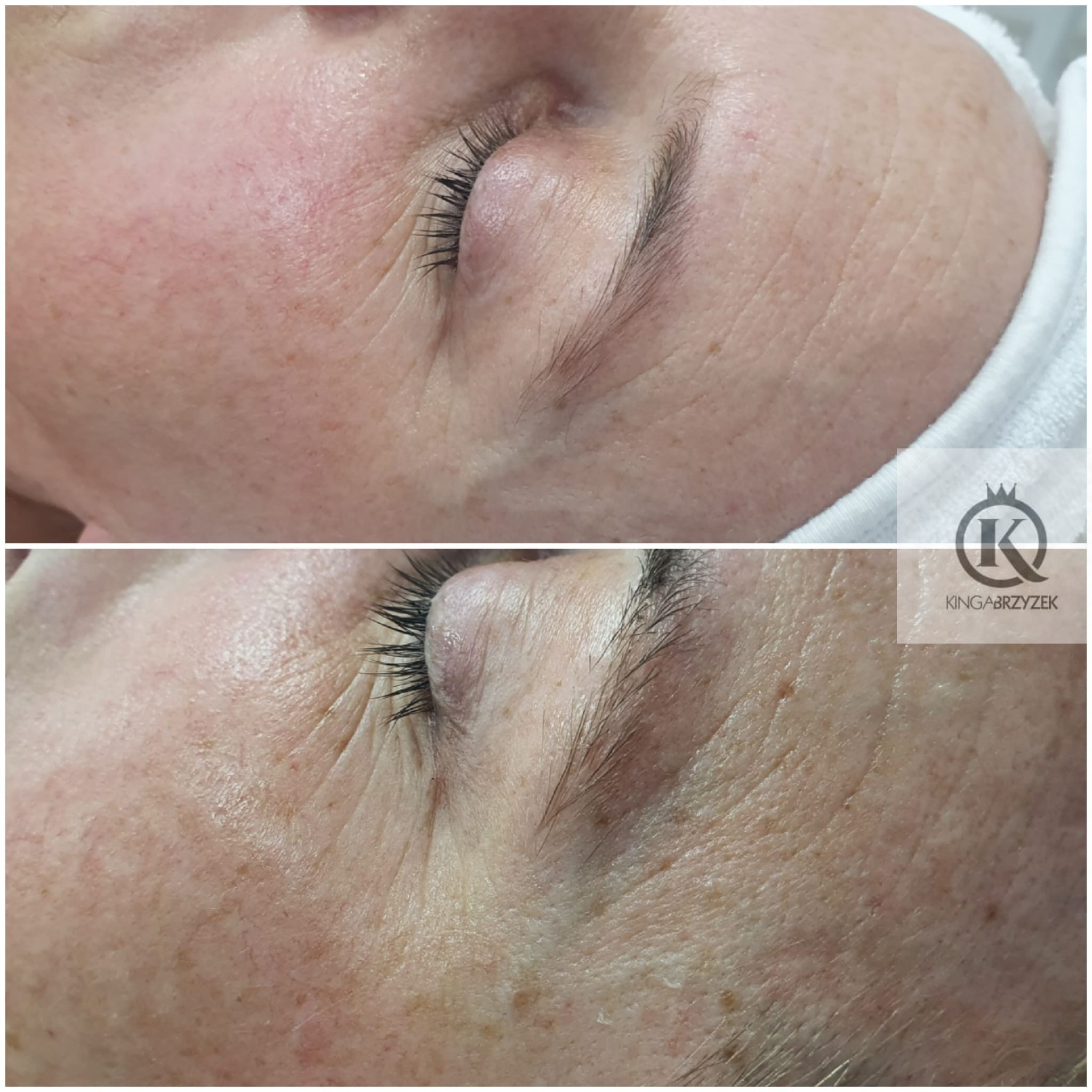 Zdjęcie przedstawia zbliżenie na skórę wokół oka przed i po zabiegu. Widoczne zmarszczki i przebarwienia są zredukowane na dolnym zdjęciu, a skóra wygląda bardziej napięta.