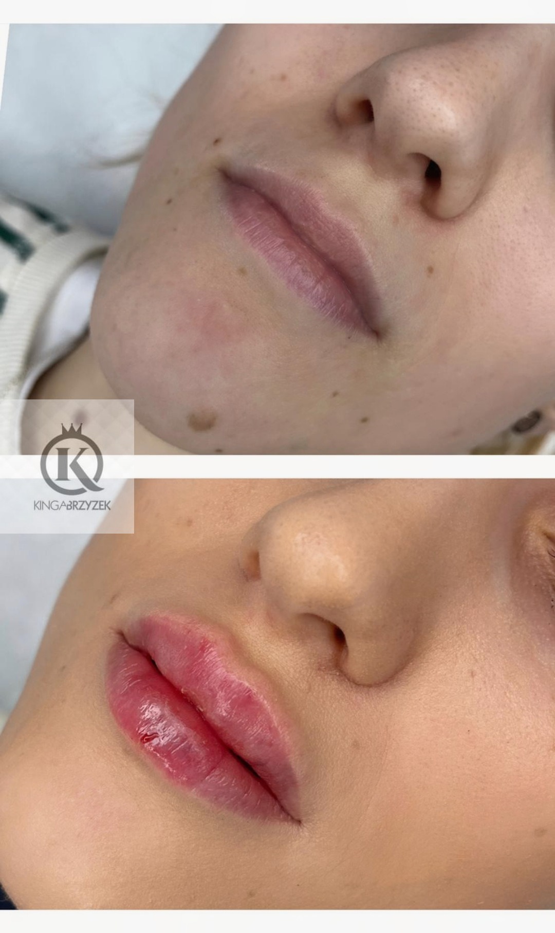 Porównanie ust przed i po zabiegu powiększania, widoczne naturalne usta przed i pełne, błyszczące usta po zabiegu, ukazujące efekt wizualny.