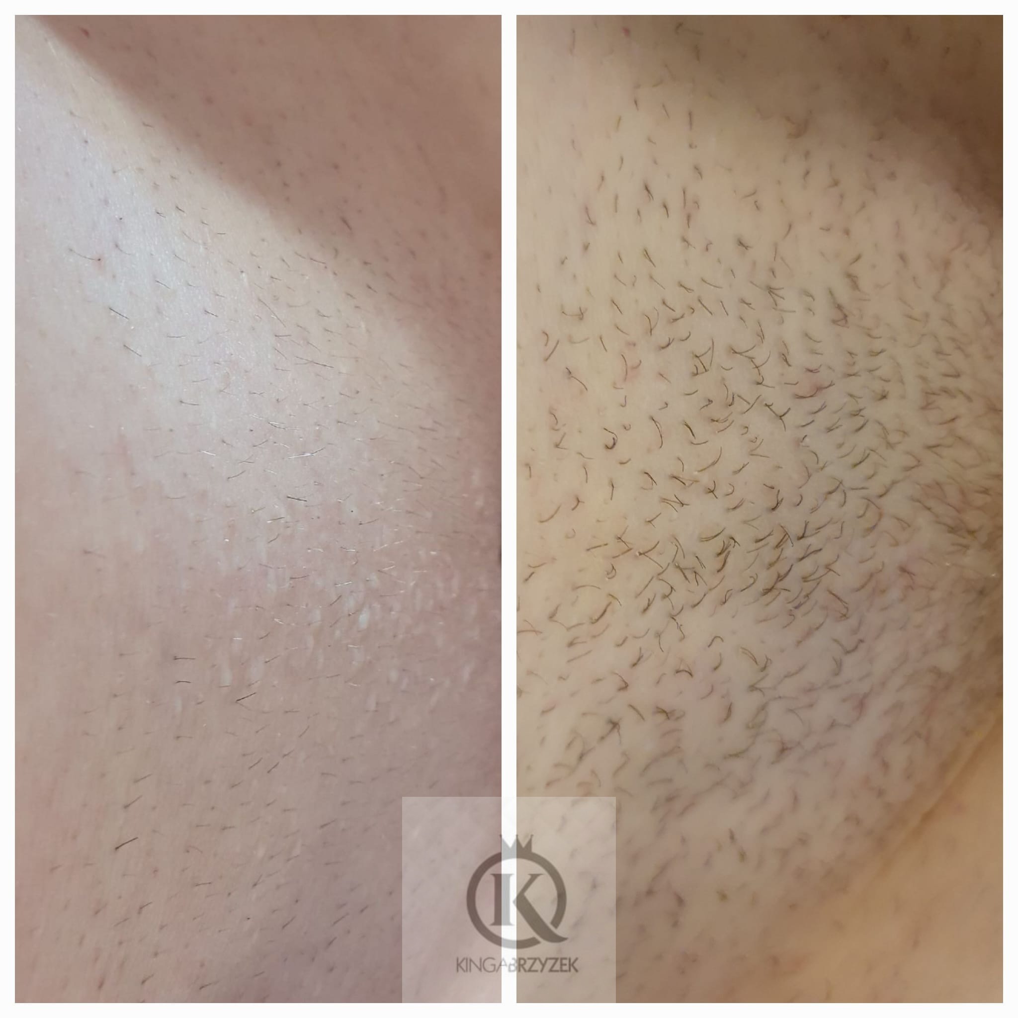 Zdjęcie porównawcze skóry przed i po depilacji, widoczne usunięte włoski i gładka skóra po zabiegu.