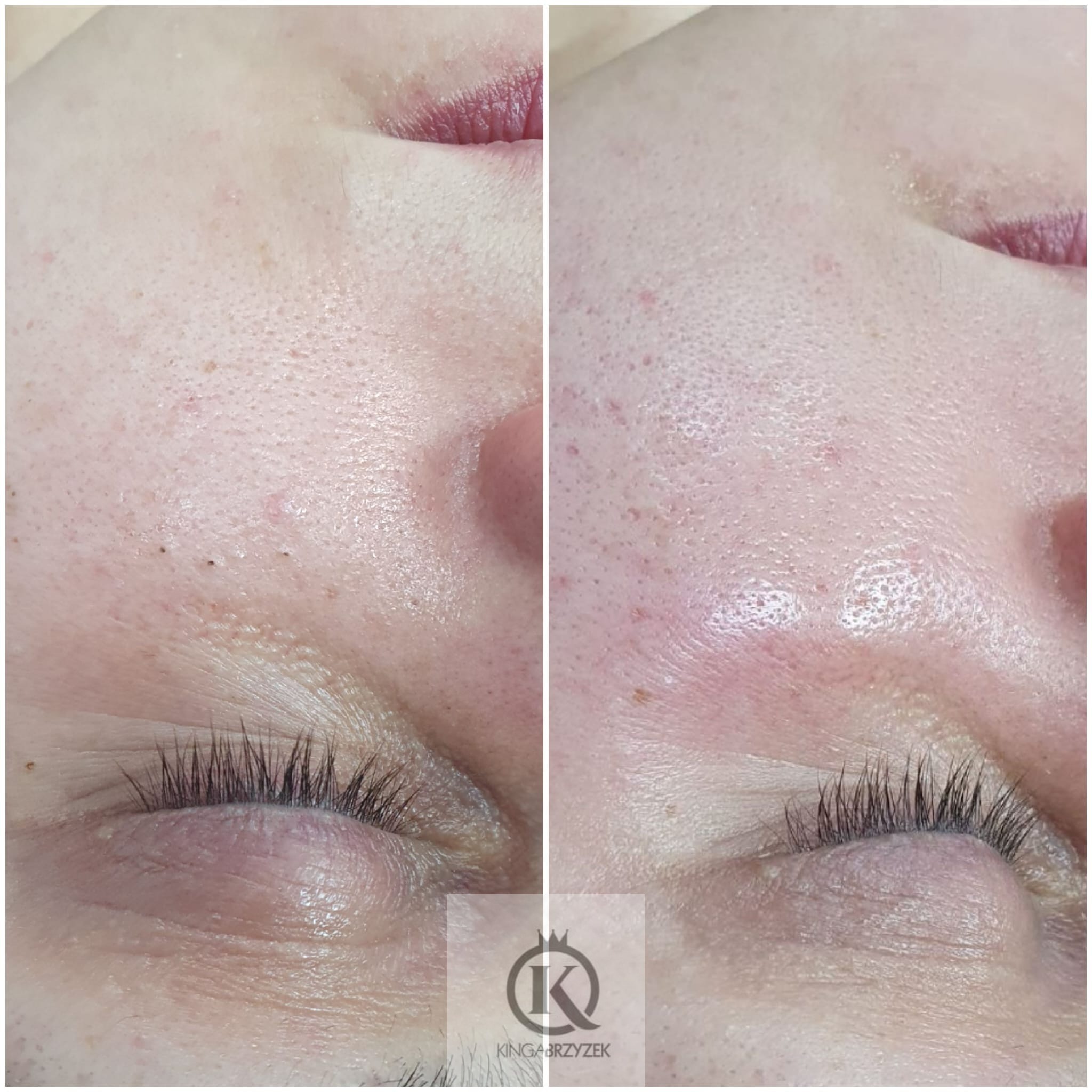 Zbliżenie na fragment twarzy przed i po zabiegu, widoczne pory i zmiany skórne, poprawa tekstury skóry po prawej stronie.