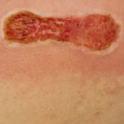 i bezpośrednio po zabiegu...