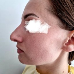 tzw. "garbek nosa" i obniżenie koniuszka nosa -tuż przed zabiegiem 