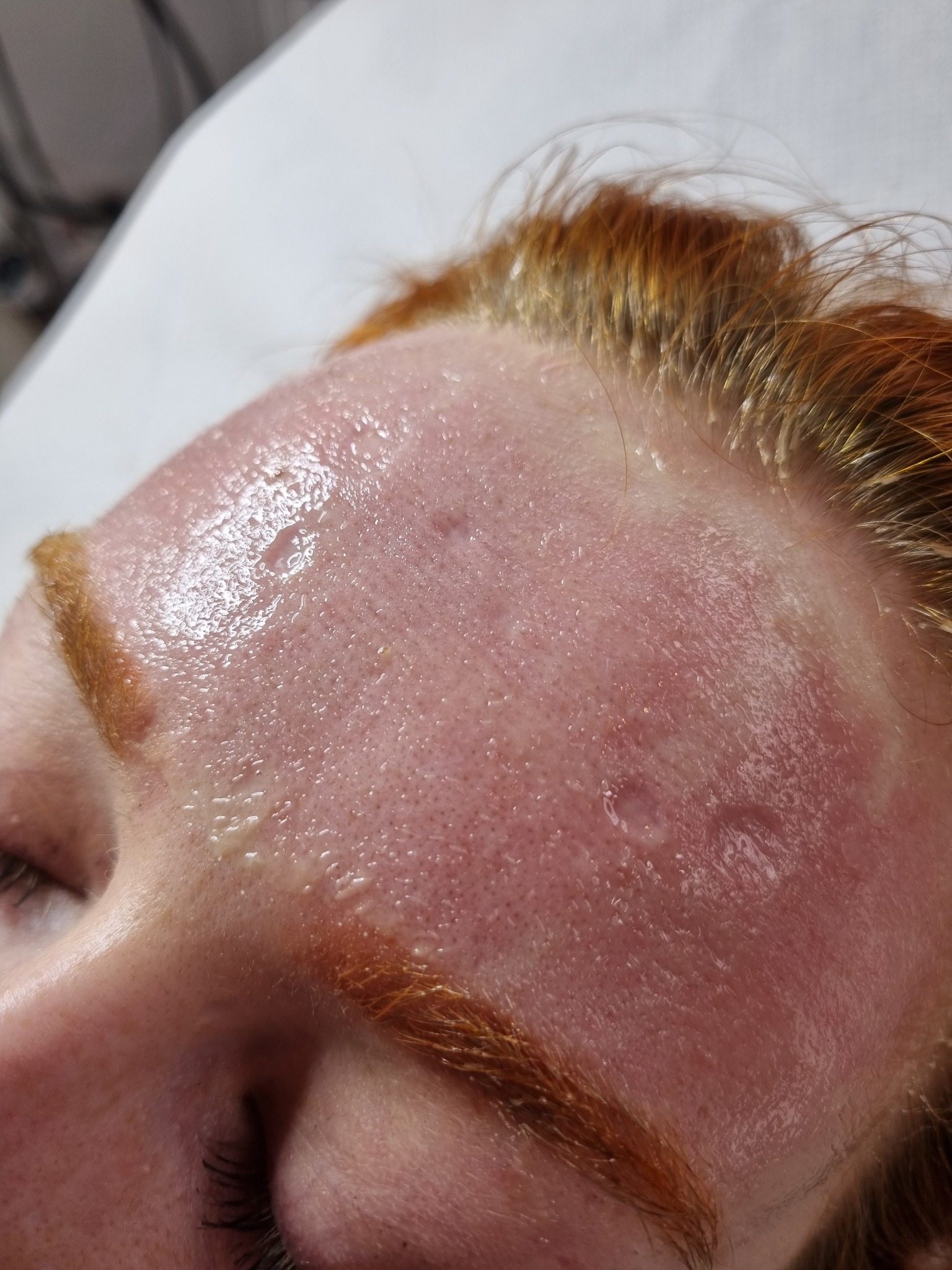 i....bezpośrednio po pierwszym zabiegu ( laser CO2 )