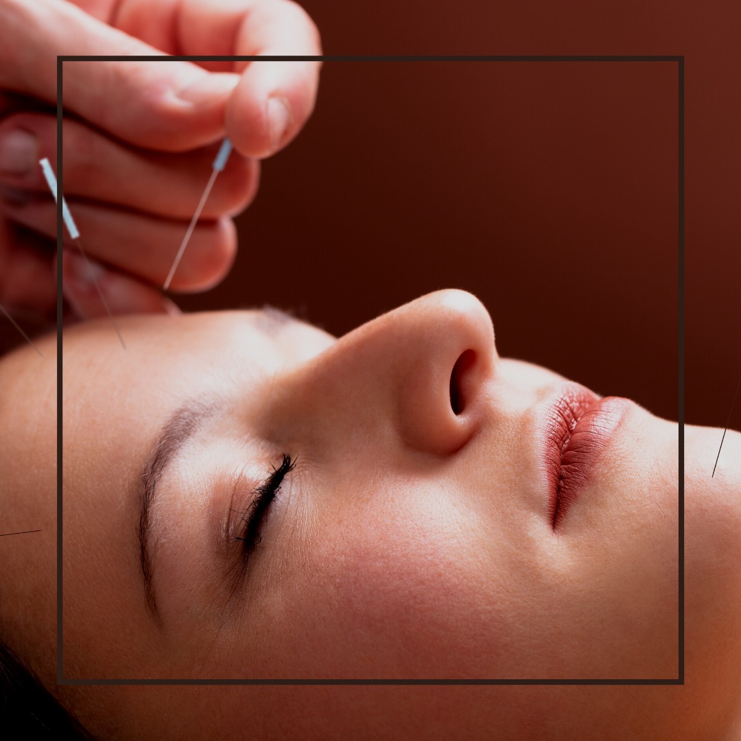 Kobieta z zamkniętymi oczami poddawana zabiegowi nakłuwania igłami przez terapeutę, zbliżenie na twarz i dłoń.