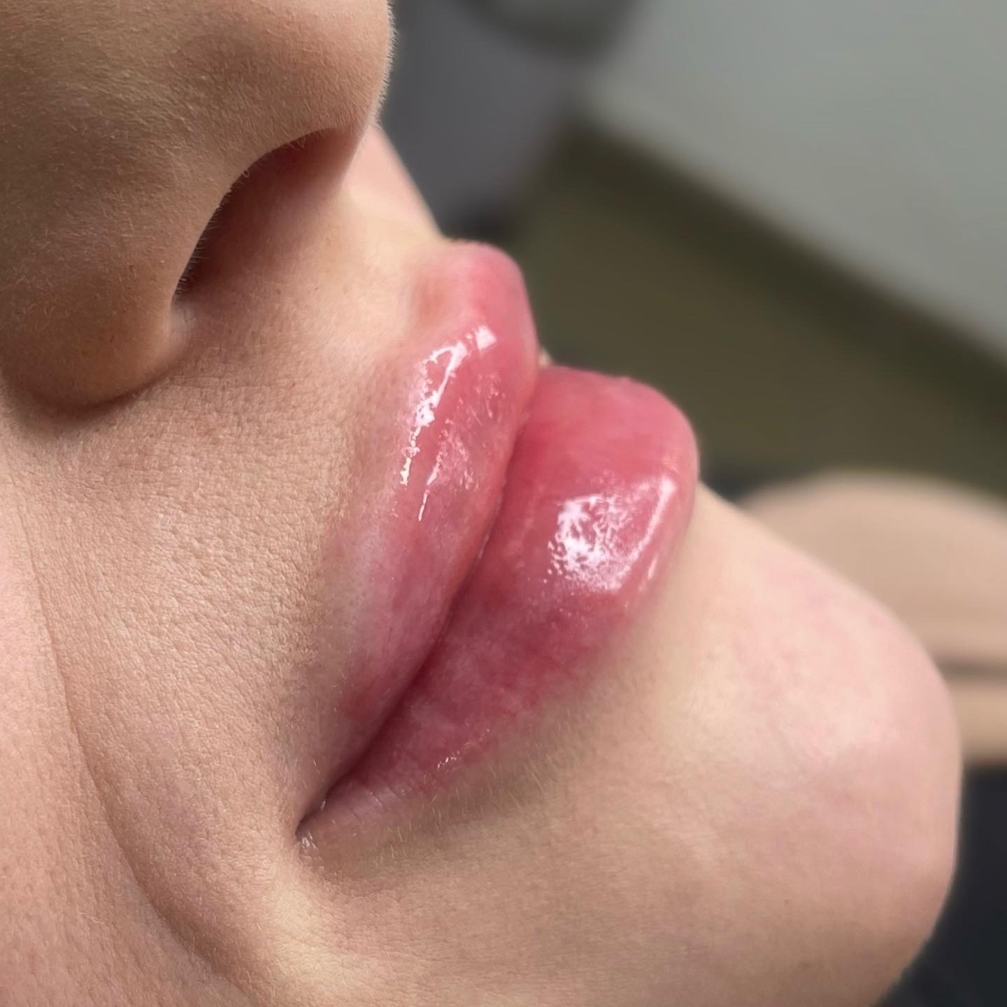 Profil zbliżeniowy ust po zabiegu modelowania kwasem hialuronowym, widoczny efekt powiększenia i połyskująca powierzchnia.