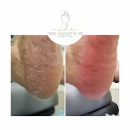 Porównanie pięty przed i po zabiegu: sucha, popękana skóra kontra gładka, nawilżona pięta. Widoczna poprawa kondycji skóry.