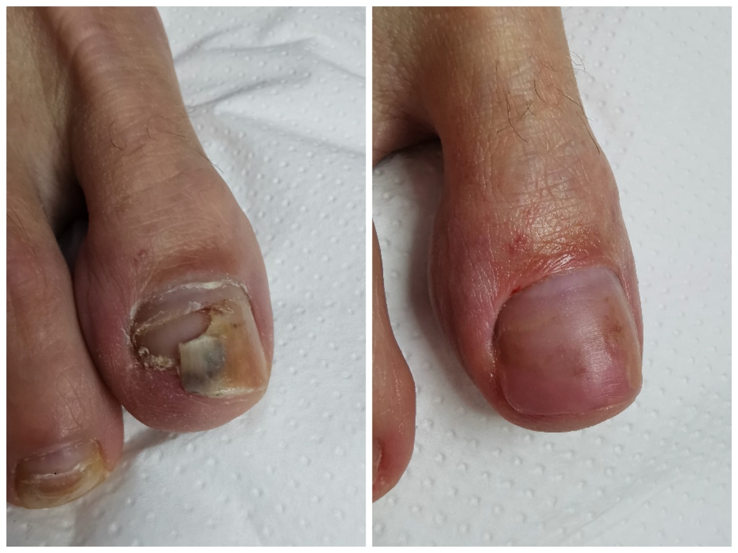 Stopa przed i po zabiegu: zniszczony paznokieć dużego palca stopy przed zabiegiem i zdrowy paznokieć po zabiegu, widoczne zmiany chorobowe.