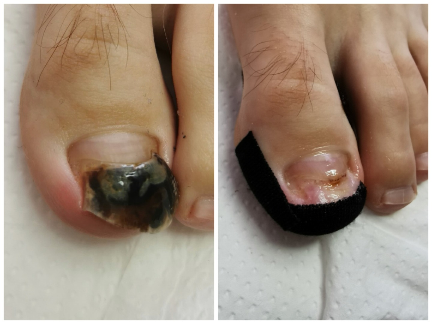 Porównanie stanu paznokcia palucha przed i po zabiegu w Gorzowie Wielkopolskim: po lewej paznokieć z krwiakiem pod płytką, po prawej paznokieć po zabiegu z nałożonym opatrunkiem.